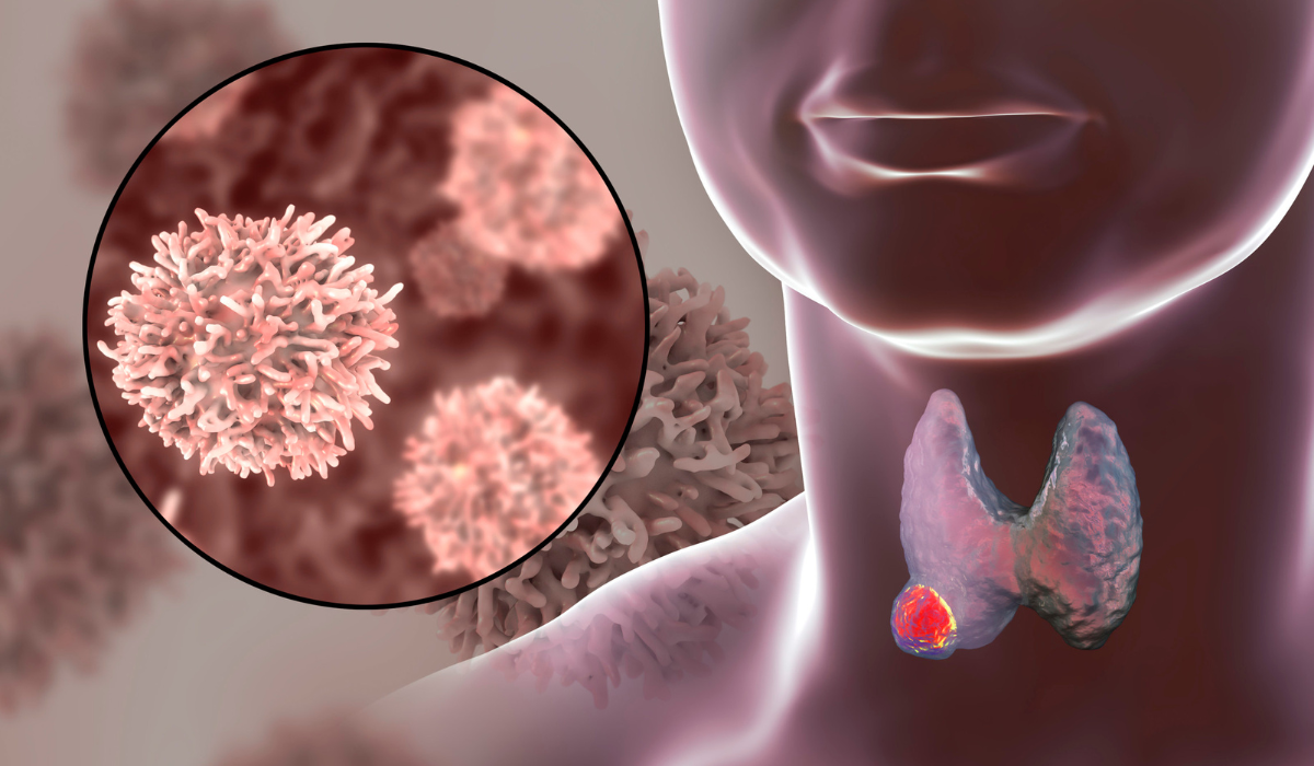 Crohn's Thyroid Disorders