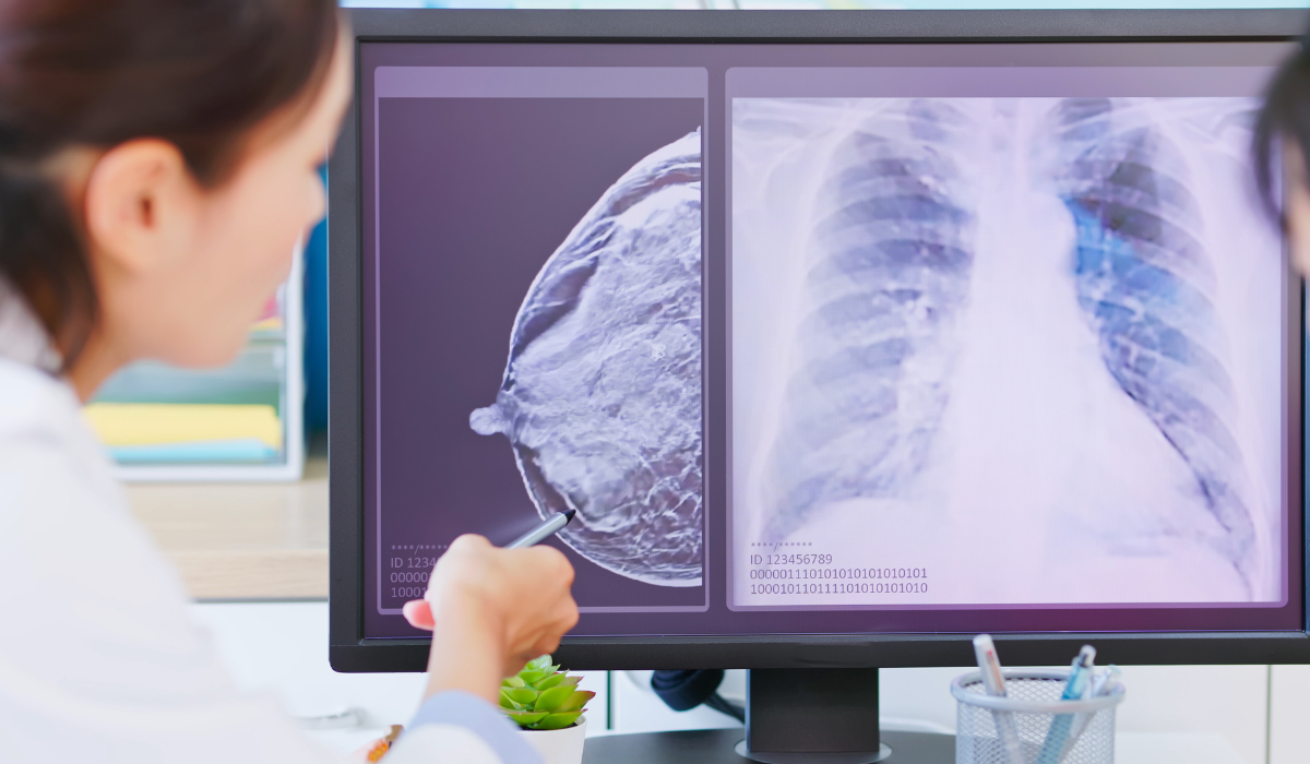 Collagen Causes Breast Cancer