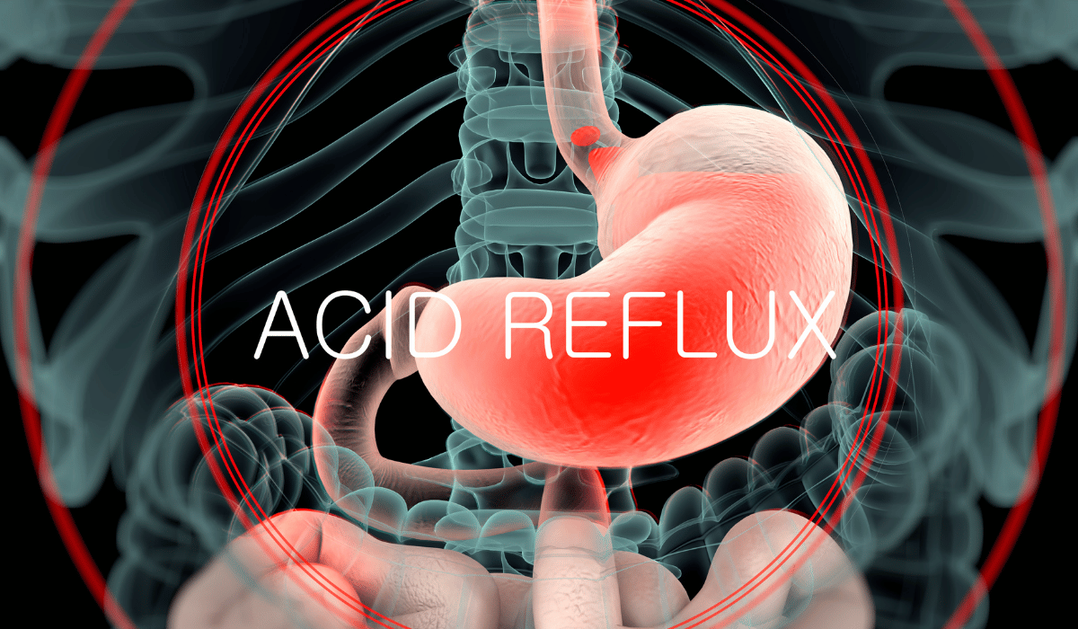 Chronic Acid Reflux Diagnosed